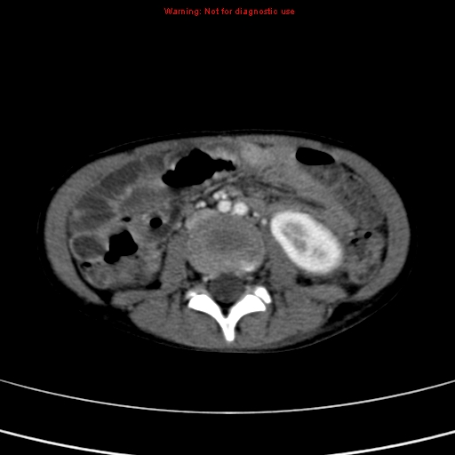 File:Adrenocortical carcinoma (Radiopaedia 9449-10131 Axial C+ portal venous phase 33).jpg