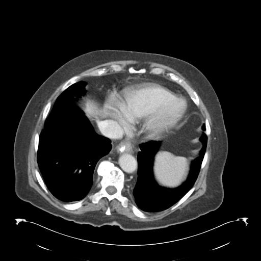 Adult ileal intussusception with secondary obstruction (Radiopaedia 30395-31051 Axial C+ portal venous phase 6).jpg