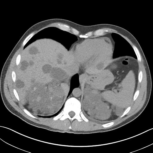 Adult polycystic kidney disease (Radiopaedia 47866-52626 Axial non-contrast 10).png