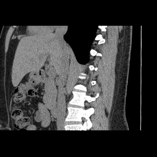 Adult polycystic kidney disease (Radiopaedia 59075-66368 Sagittal non-contrast 35).jpg