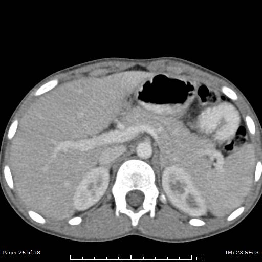 Agenesis of the gallbladder (Radiopaedia 55454-61905 B 26).jpg