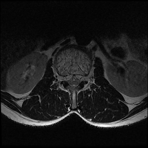 File:Aggressive vertebral hemangioma with pathological fracture (Radiopaedia 69528-79411 Axial T2 13).jpg