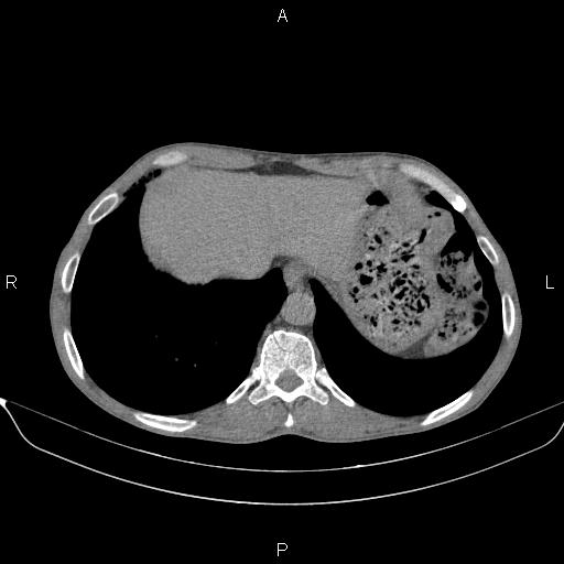 Air bronchogram in pneumonia (Radiopaedia 85719-101512 Axial non-contrast 57).jpg