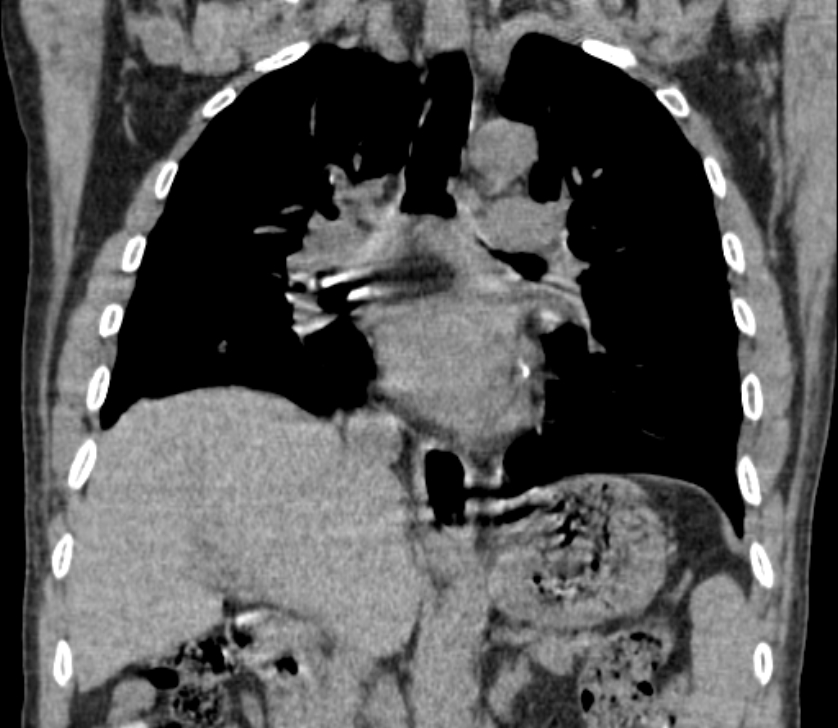 Airway foreign body in adult (Radiopaedia 85907-101779 Coronal liver window 143).jpg