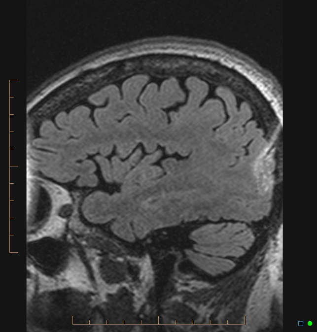 Aliasing artifact causing a spurious cerebellar lesion (Radiopaedia 48783-53810 Sagittal FLAIR 106).jpg