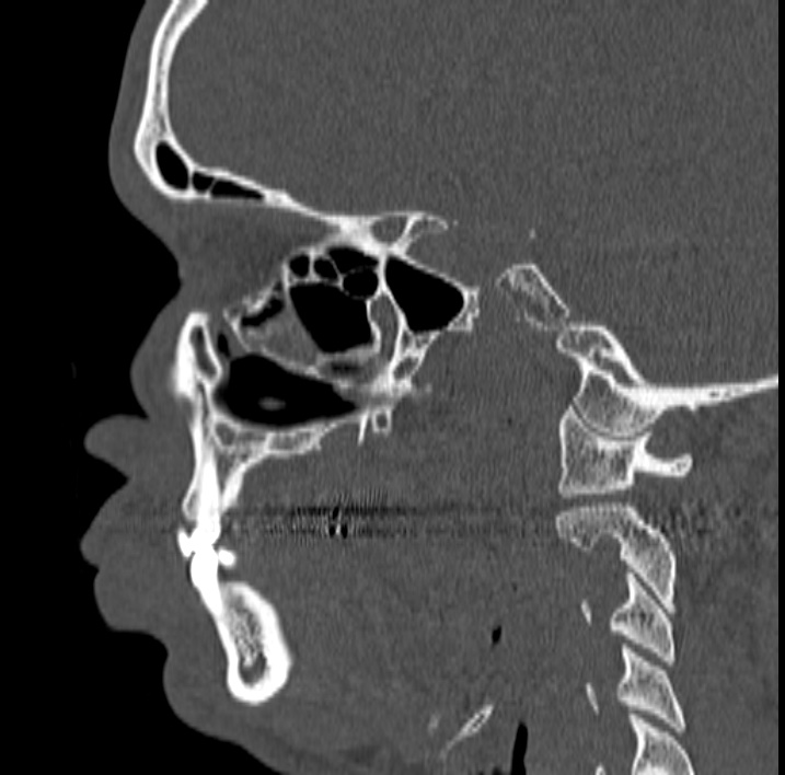 Ameloblastoma (Radiopaedia 77750-89997 Sagittal bone window 12).jpg