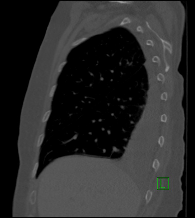 Amiodarone deposition in the liver (Radiopaedia 77587-89780 Sagittal bone window 74).jpg