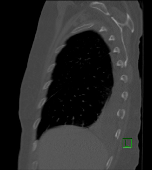 Amiodarone deposition in the liver (Radiopaedia 77587-89780 Sagittal bone window 79).jpg