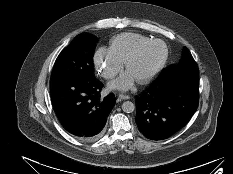 Amiodarone lung (Radiopaedia 62514-70769 Axial non-contrast 60).jpg