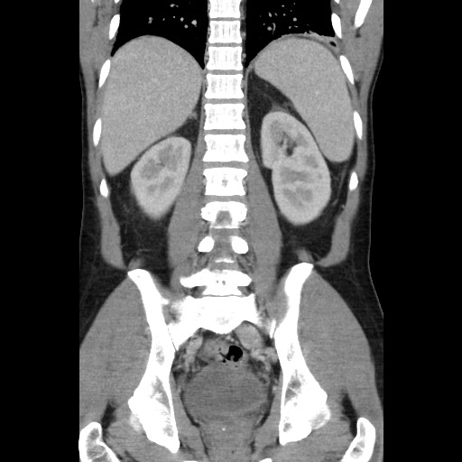 Amoebic liver abscesses (Radiopaedia 55536-62009 B 36).jpg