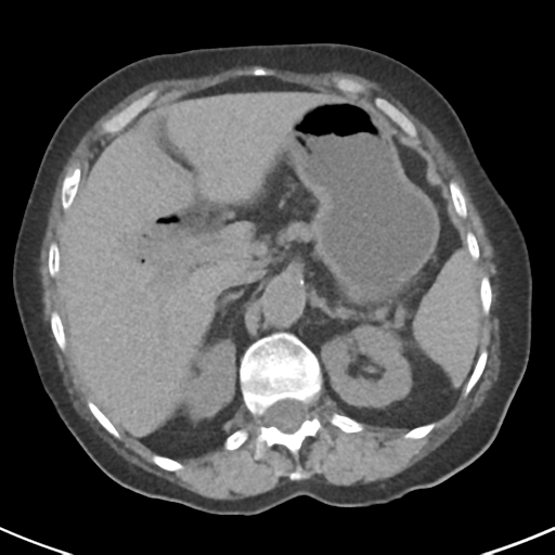 File:Ampullary adenocarcinoma (Radiopaedia 34013-35237 Axial non-contrast 14).png