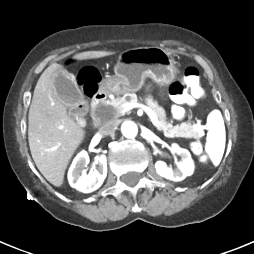 Ampullary adenocarcinoma (Radiopaedia 34013-35237 B 31).png