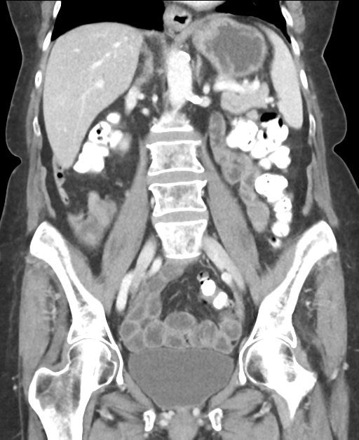 Ampullary adenocarcinoma (Radiopaedia 34013-35237 E 29).png