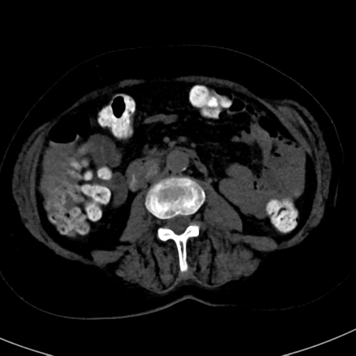 File:Ampullary adenocarcinoma (Radiopaedia 34013-35241 AXIAL THICK 52).png