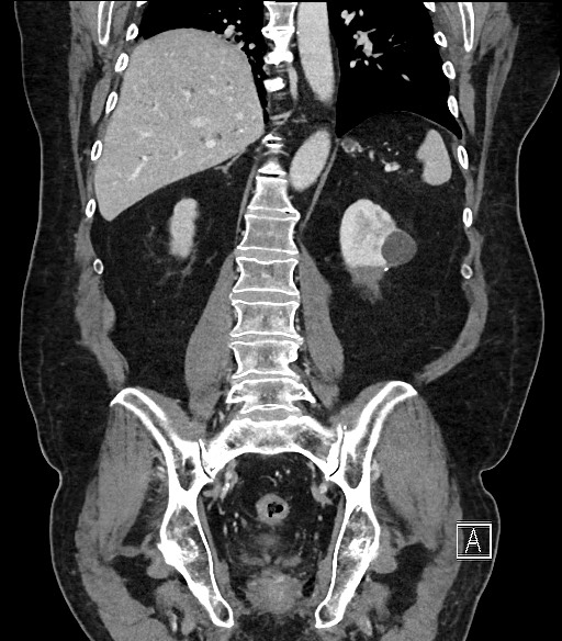 Ampullary adenocarcinoma (Radiopaedia 59373-66734 D 76).jpg