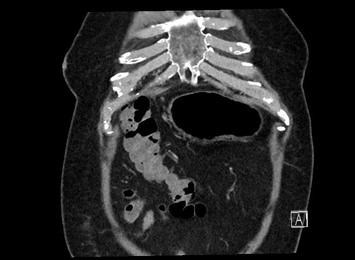 Ampullary adenocarcinoma (Radiopaedia 59373-66737 B 12).jpg