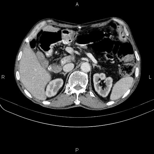 Ampullary adenocarcinoma (Radiopaedia 86093-102033 B 59).jpg