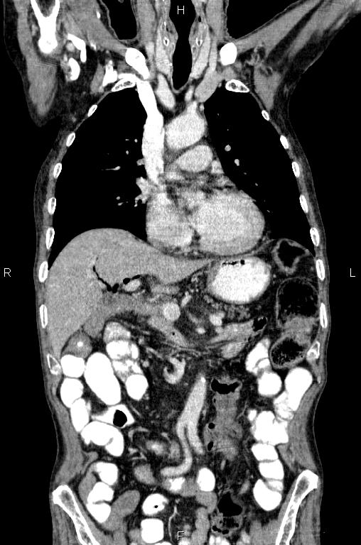 Ampullary adenocarcinoma (Radiopaedia 86093-102033 D 24).jpg