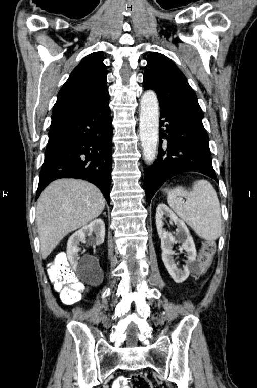 Ampullary adenocarcinoma (Radiopaedia 86093-102033 D 45).jpg