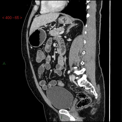 Ampullary carcinoma (Radiopaedia 56396-63056 D 64).jpg