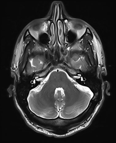 File:Amyotrophic lateral sclerosis (Radiopaedia 87352-103658 Axial T2 5).jpg