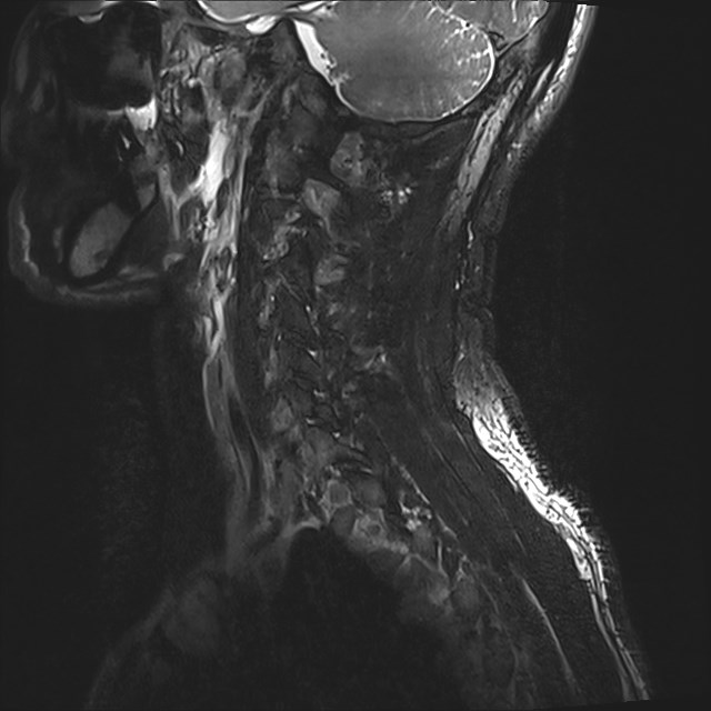 Amyotrophic lateral sclerosis (Radiopaedia 87352-103658 I 3).jpg