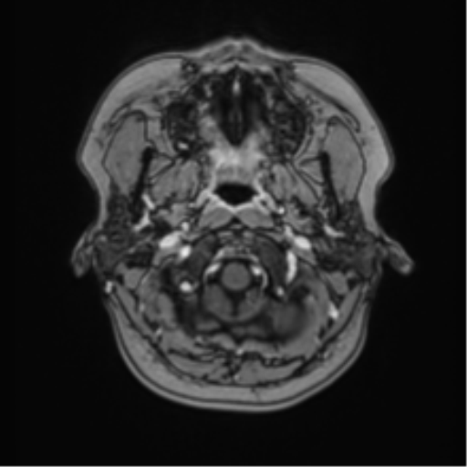 Anaplastic astroblastoma (Radiopaedia 55666-62194 Axial T1 C+ 6).png