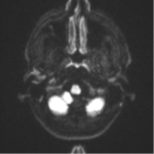 Anaplastic astrocytoma (Radiopaedia 57768-64731 Axial DWI 30).png