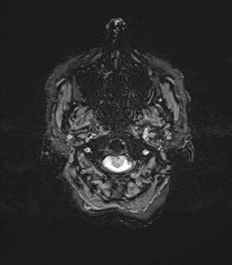 File:Anaplastic astrocytoma (Radiopaedia 86943-103160 Axial SWI 5).png