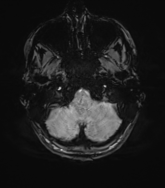 File:Anaplastic astrocytoma IDH mutant (Radiopaedia 50046-55341 Axial SWI 14).png