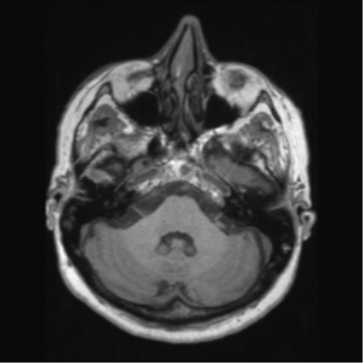 File:Anaplastic astrocytoma IDH wild-type (pseudoprogression) (Radiopaedia 42209-45276 Axial T1 42).png