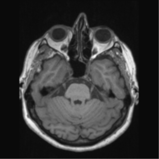 Anaplastic astrocytoma IDH wild-type (pseudoprogression) (Radiopaedia 42209-45276 Axial T1 52).png