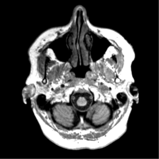 Anaplastic astrocytoma IDH wild-type (pseudoprogression) (Radiopaedia 42209-45277 Axial T1 10).png