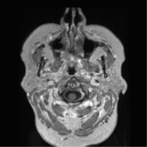 File:Anaplastic astrocytoma IDH wild-type (pseudoprogression) (Radiopaedia 42209-45278 Axial T1 C+ 15).png
