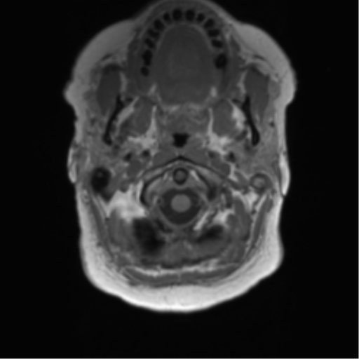 Anaplastic oligodendroglioma (Radiopaedia 83500-98599 Axial T1 5).png