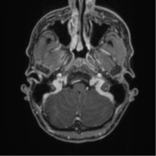 Anaplastic oligodendroglioma with skull fracture (Radiopaedia 74831-85845 Axial T1 C+ fat sat 4).png