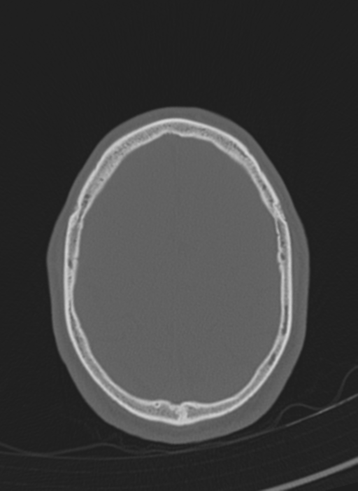 Anaplastic oligodendroglioma with skull fracture (Radiopaedia 74831-85846 Axial bone window 5).png