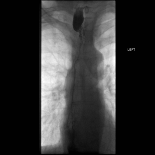 File:Anastomotic stricture post Ivor Lewis esophagectomy (Radiopaedia 47937-52715 B 28).png