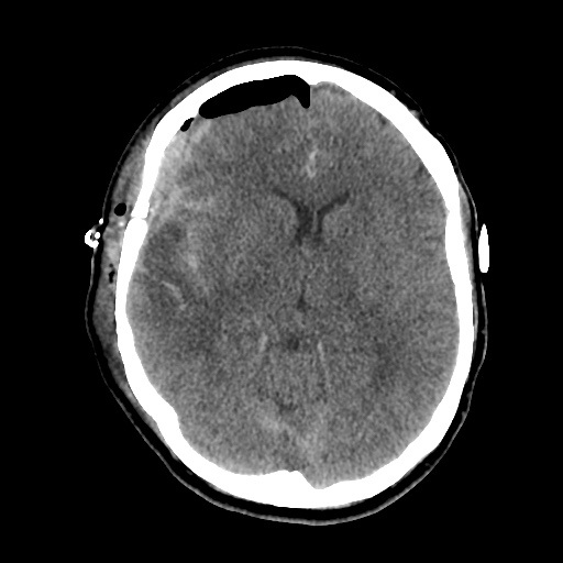 Aneursym related subarachnoid hemorrhage with hydrocephalus (Radiopaedia 45105-49085 Axial non-contrast 23).jpg