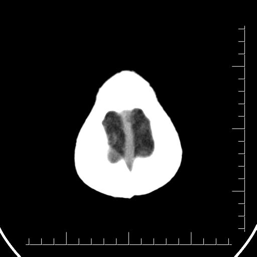 Aneurysm of posterior communicating artery (Radiopaedia 20188-20162 Axial non-contrast 47).jpg