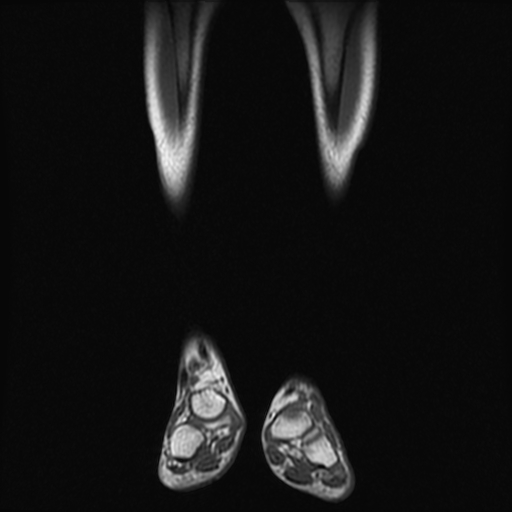 File:Aneurysmal bone cyst - tibia (Radiopaedia 22343-22367 Coronal T1 3).jpg