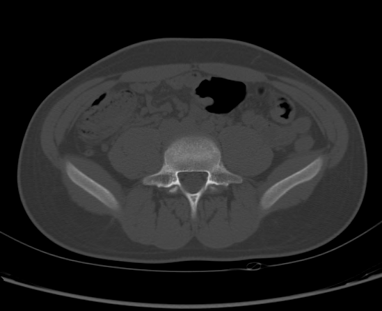 File:Aneurysmal bone cyst of ischium (Radiopaedia 25957-26094 Axial bone window 9).png