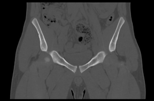 File:Aneurysmal bone cyst of ischium (Radiopaedia 25957-26094 Coronal bone window 12).png