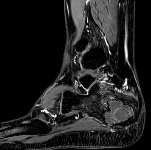 File:Aneurysmal bone cyst of the calcaneus (Radiopaedia 60669-68420 F 7).jpg
