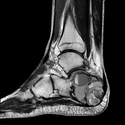 File:Aneurysmal bone cyst of the calcaneus (Radiopaedia 60669-68420 Sagittal PD 9).jpg