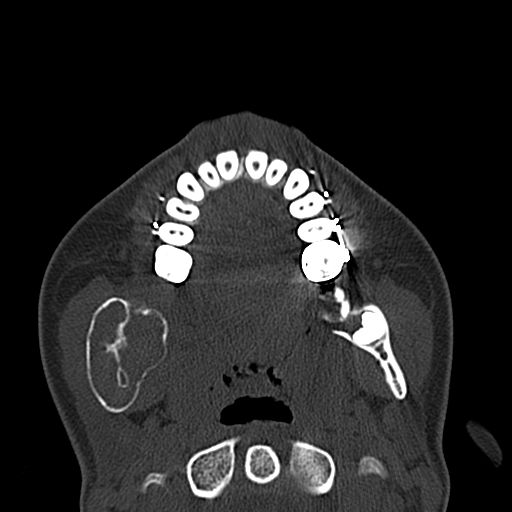 Aneurysmal bone cyst of the mandible (Radiopaedia 43280-46601 Axial bone window 38).jpg