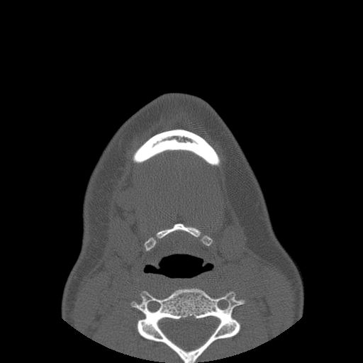 File:Aneurysmal bone cyst of the mandible (Radiopaedia 43280-46823 Axial bone window 9).jpg