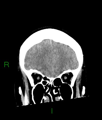 Aneurysmal subarachnoid hemorrhage with intra-axial extension (Radiopaedia 84371-99699 Coronal non-contrast 52).jpg