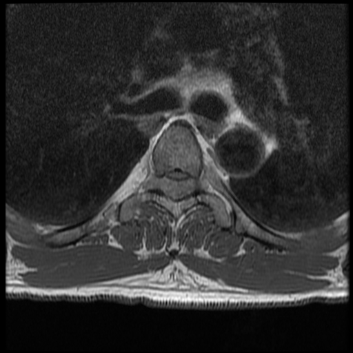 File:Angiolipoma - thoracic spine (Radiopaedia 28242-28479 Axial T1 18).jpg