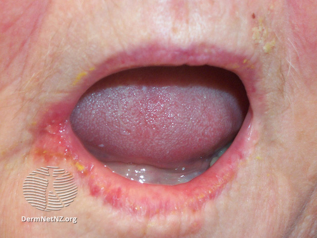File:Angular cheilitis (DermNet NZ site-age-specific-perleche8).jpg